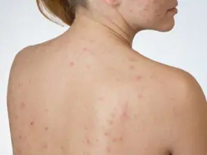Skin Tightening