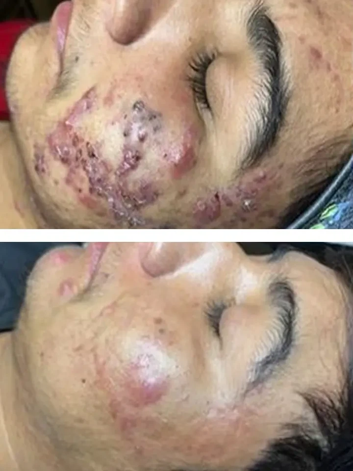 Acne Treatment