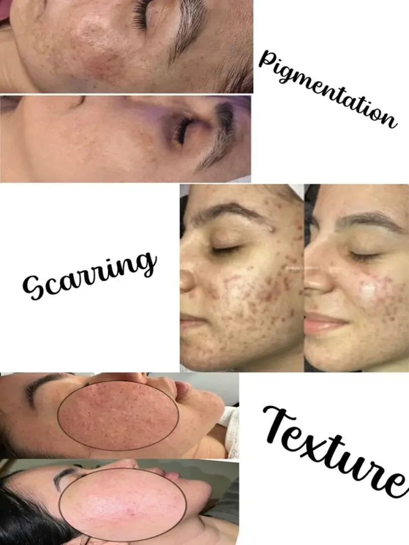 Pigmentation & Scarring